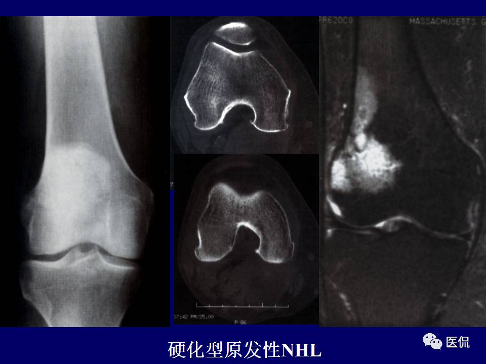 徐文坚老师精讲：原发性骨淋巴瘤影像学诊断医学影像精品PPT
