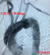 来了！建军节特别行动之探秘“主动脉夹层”