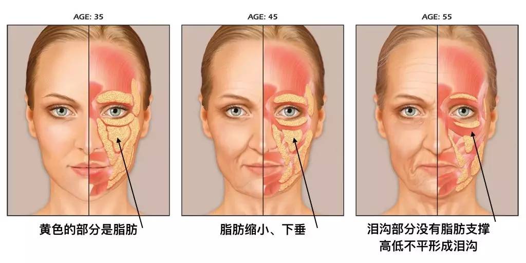 泪沟法令纹颈纹显老怎么办,改善泪沟法令纹全脸提升的方法