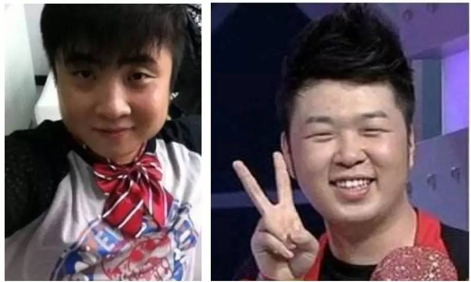 泪沟法令纹颈纹显老怎么办,改善泪沟法令纹全脸提升的方法