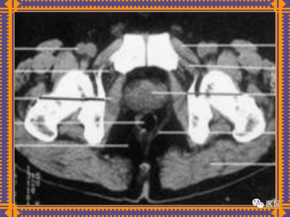 生殖系统疾病影像学诊断医学影像精品PPT