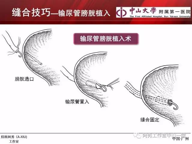 妇科腹腔镜下常用缝合技巧