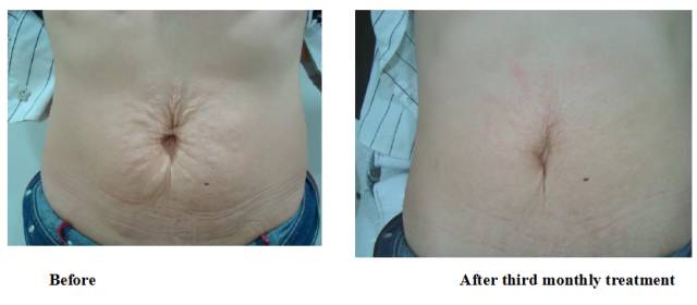 徐医附院美容中心整形案例,徐医附院整形美容中心祛痣