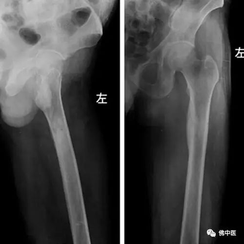 「高超」微创直达深巢，射频消融病灶，佛中医治疗骨样骨瘤有新招