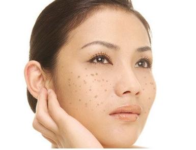 10岁男孩脸上长斑怎么消除,50岁女人脸上长斑怎么消除
