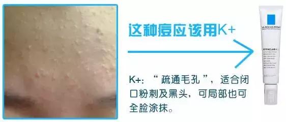 痘痘闭口痘印黑头,痘痘闭口毛孔粗大修复