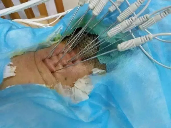 内热针是全针发热还是针尖发热,浮针治疗颈肩腰腿痛怎么样