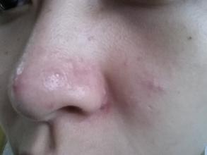 鼻子上挤出的白色条状物到底是啥,鼻子两边能挤出白色东西的是什么