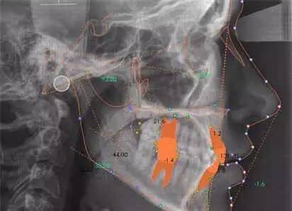 戴牙套为什么会矫正,牙套贵的和便宜的区别