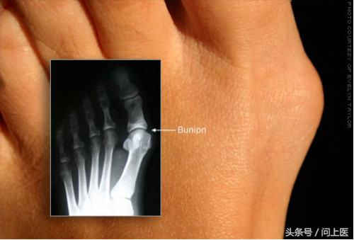 你的脚部是否有这4个特征,脚部反射图及疾病大图解