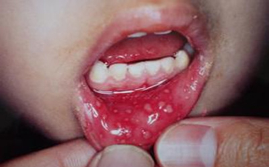 如何预防手足口病小常识,手足口病症状和预防方法