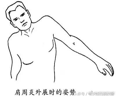 肩冻结能自愈吗,空调肩如何治疗