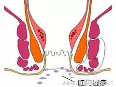 复杂性肛周脓肿怎么治疗能除根,肛周脓肿症状怎么治疗比较好呢