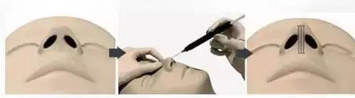 鼻子不好看的女性,线雕鼻做好鼻梁太细是什么原因