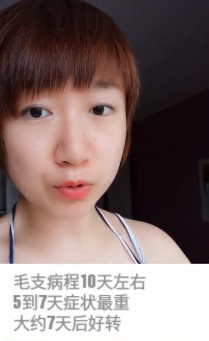 病毒性气管支气管炎症状,急性毛细支气管炎的最佳治疗