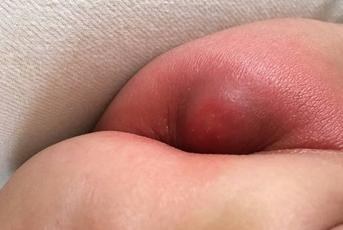 4岁宝宝吃糖丸后致残,宝宝没能按时服用糖丸