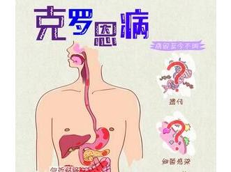 听说过克罗恩病吗,克罗恩病通俗地讲是什么病