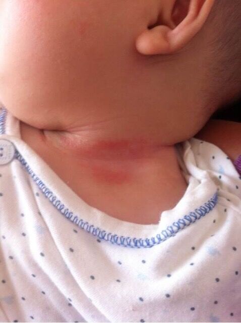 宝宝淹脖子的正确做法,淹脖子护理方法超详细