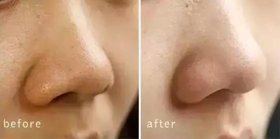 如何不挤就可以去黑头,黑头别再用手挤三个去黑头小妙招