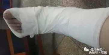 踝关节骨折没有手术怎么办,骨折保守治疗可以活动踝关节吗