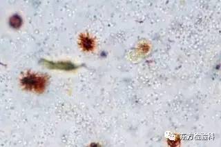 尿中结晶达到多少就是结石了,尿结晶数高是病吗