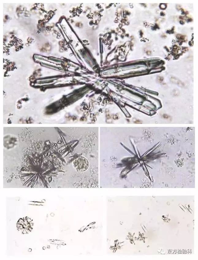 尿中结晶达到多少就是结石了,尿结晶数高是病吗