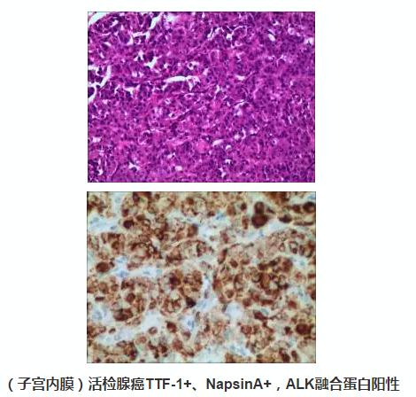 肿瘤病人案例,肺癌会转移到子宫内膜癌吗