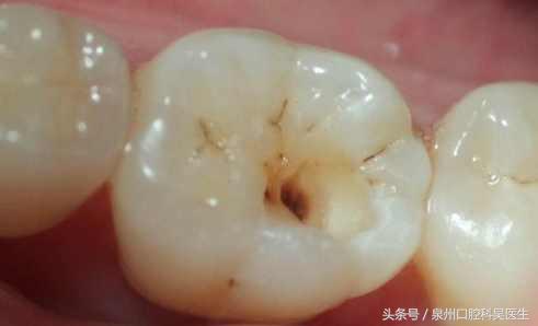 保留坏牙的几种方法,坏牙是不是越早拔越好