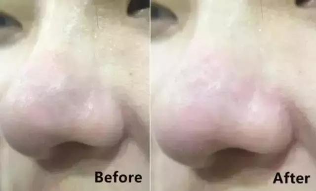 控油祛痘祛黑头粉刺闭口面膜推荐,哪种清洁面膜祛黑头粉刺有效果