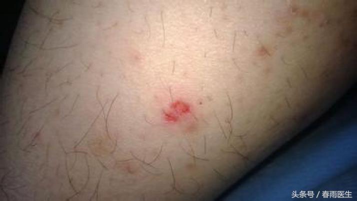 被狗咬了打狂犬疫苗打一针可以吗,被狗咬了打狂犬疫苗