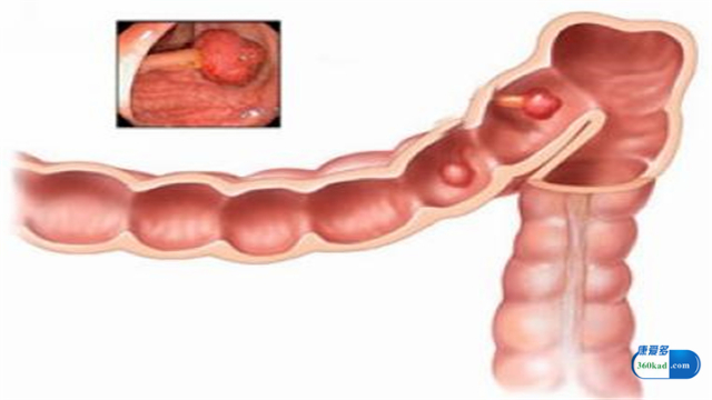 复方斑蝥胶囊治疗肺癌效果好吗,复方斑蝥胶囊治肺癌效果