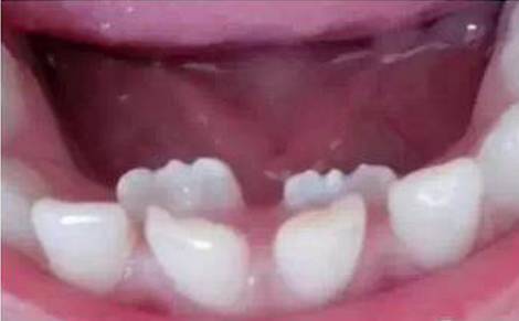 孩子长了“双排牙”要立即拔吗？听牙医怎么说