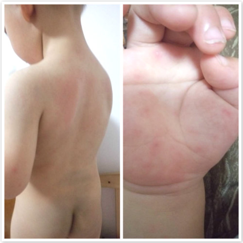 手足口病会传染成疱疹性咽峡炎吗,疱疹性咽峡炎还会感染手足口么