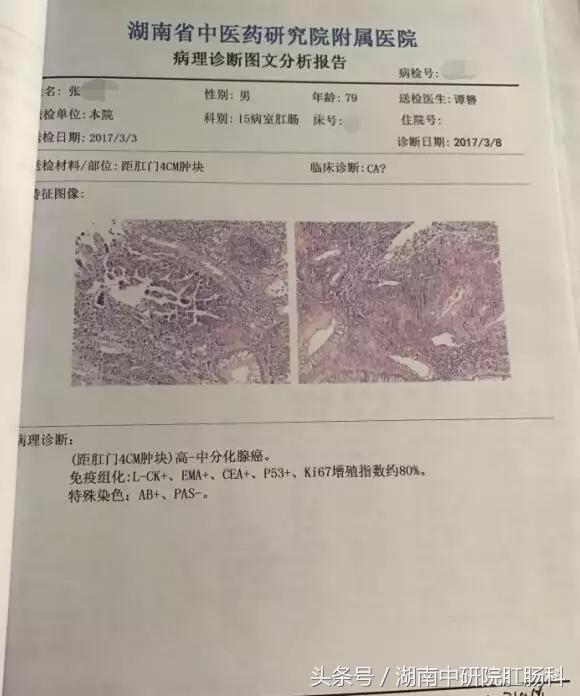 低位直肠癌冷冻治疗,直肠癌冷冻