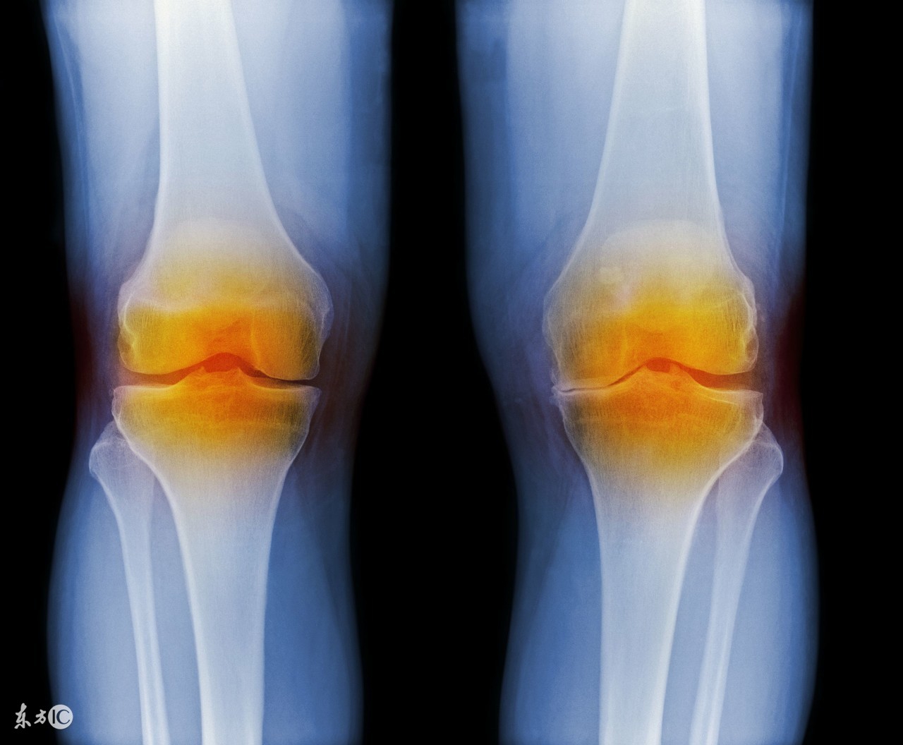 骨科专家谈关节炎,骨性关节炎的分型和表现