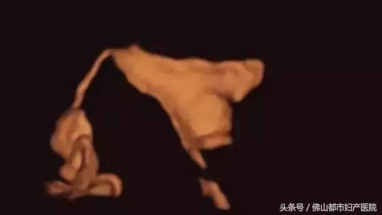 输卵管四维超声造影，不孕患者的福音