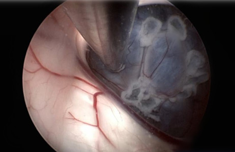 神经内镜治疗蛛网膜囊肿,颅内蛛网膜囊肿外科治疗方法