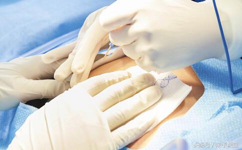 你真正提前了解过剖腹产吗？是什么理由让他们拒绝剖腹产！