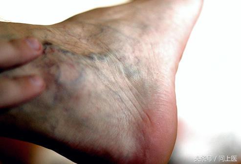 脚部肿胀走路就疼是啥原因,脚肿伴有麻木是什么病的前兆