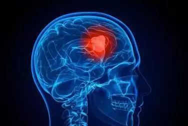 肺癌脑转移脑肿瘤54mm怎么办,肺癌脑转移9291耐药期