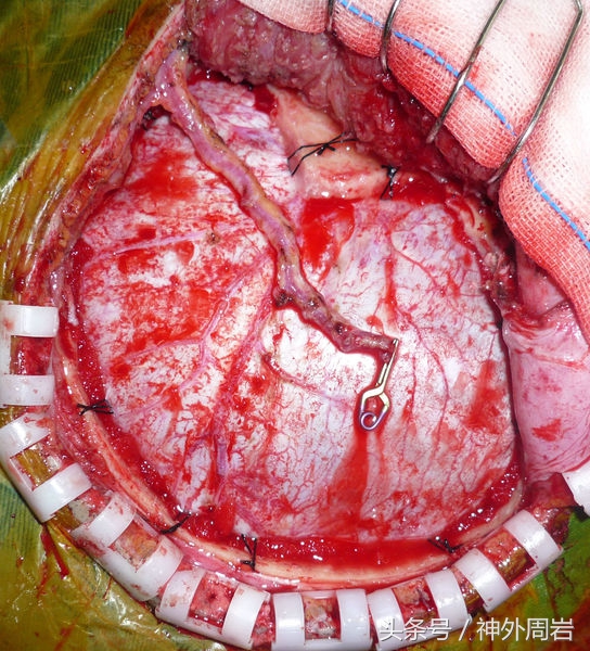 烟雾病脑内出血,烟雾病脑室出血死亡率