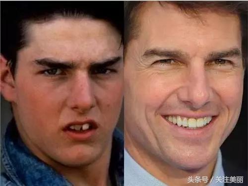 戴了牙套后嘴唇会变薄吗,戴牙套后会导致嘴变凸吗