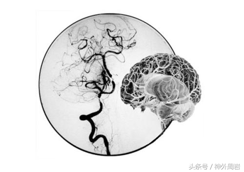 烟雾病脑内出血,烟雾病脑室出血死亡率
