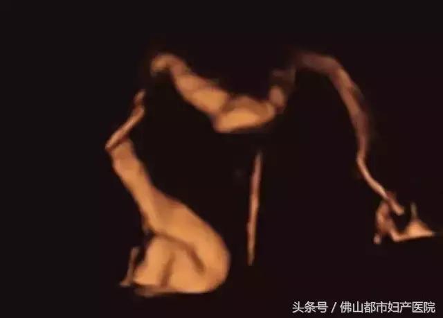 四维超声输卵管造影亲身经历,无痛四维输卵管造影