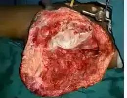 创面感染用什么抗生素,创面感染最佳治疗方案