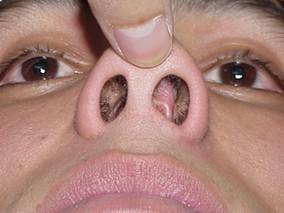 鼻甲肥大是不是就是腺样体肥大,鼻甲肥大是不是鼻头看起来比较大