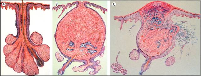 痘疮最好的治疗方法,疮疡和痘痘有什么区别