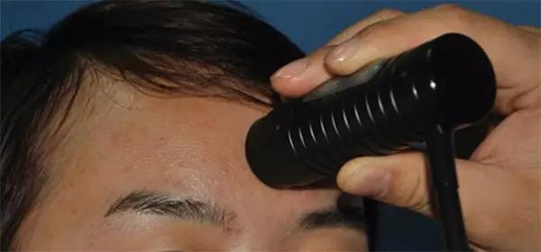 额部皱纹注射玻尿酸,额部注射除皱