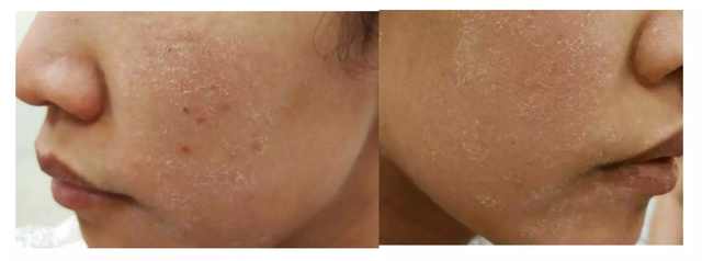 激素依赖性皮炎修复期什么样,激素依赖性皮炎怎么算彻底修复好