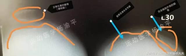 习惯性髌骨脱位微创手术,髌骨习惯性脱位手术刀疤